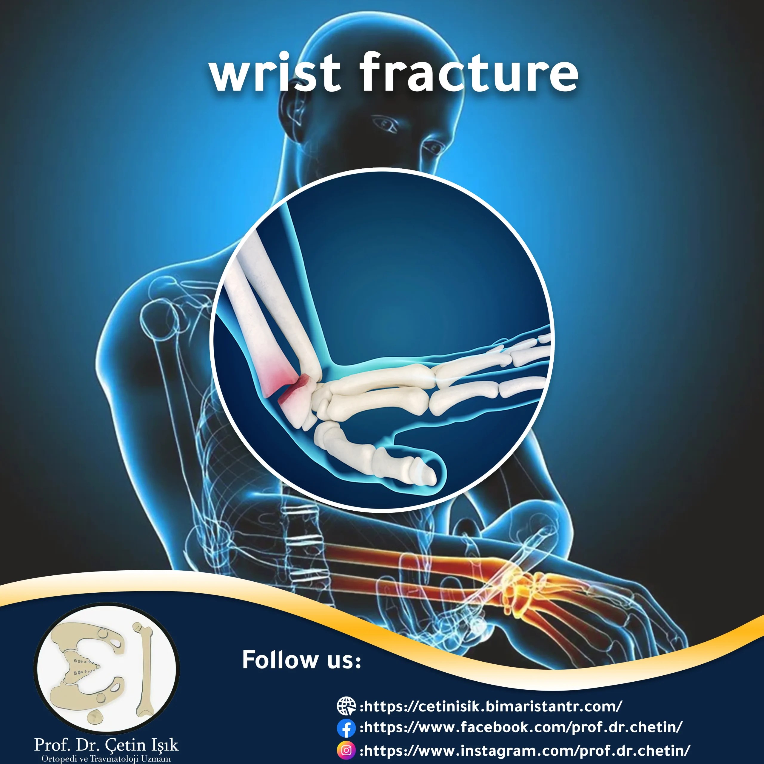 Fracture of the hand joint, how to diagnose it and treat it Dr. What
