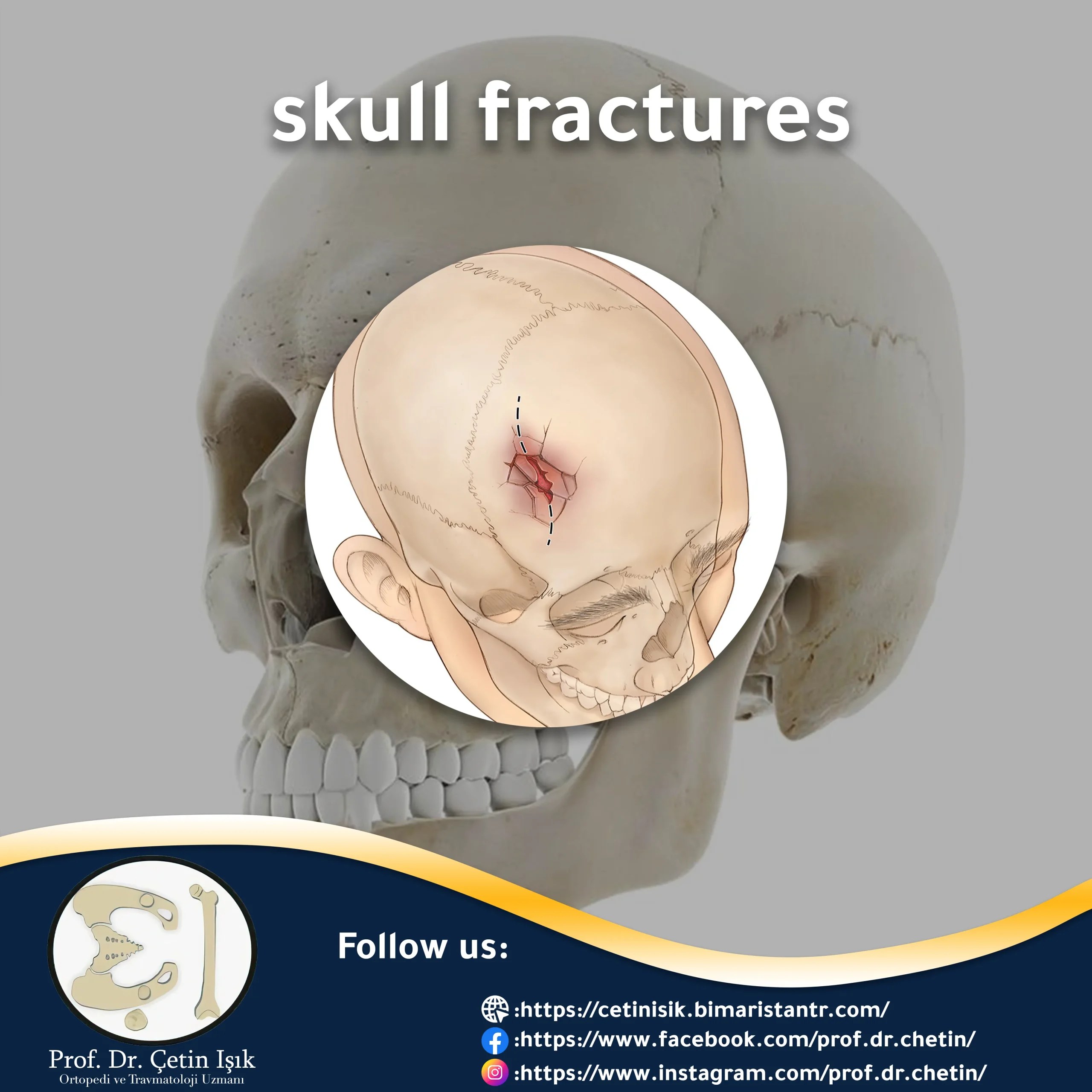 Skull fractures the most important symptoms and treatment methods