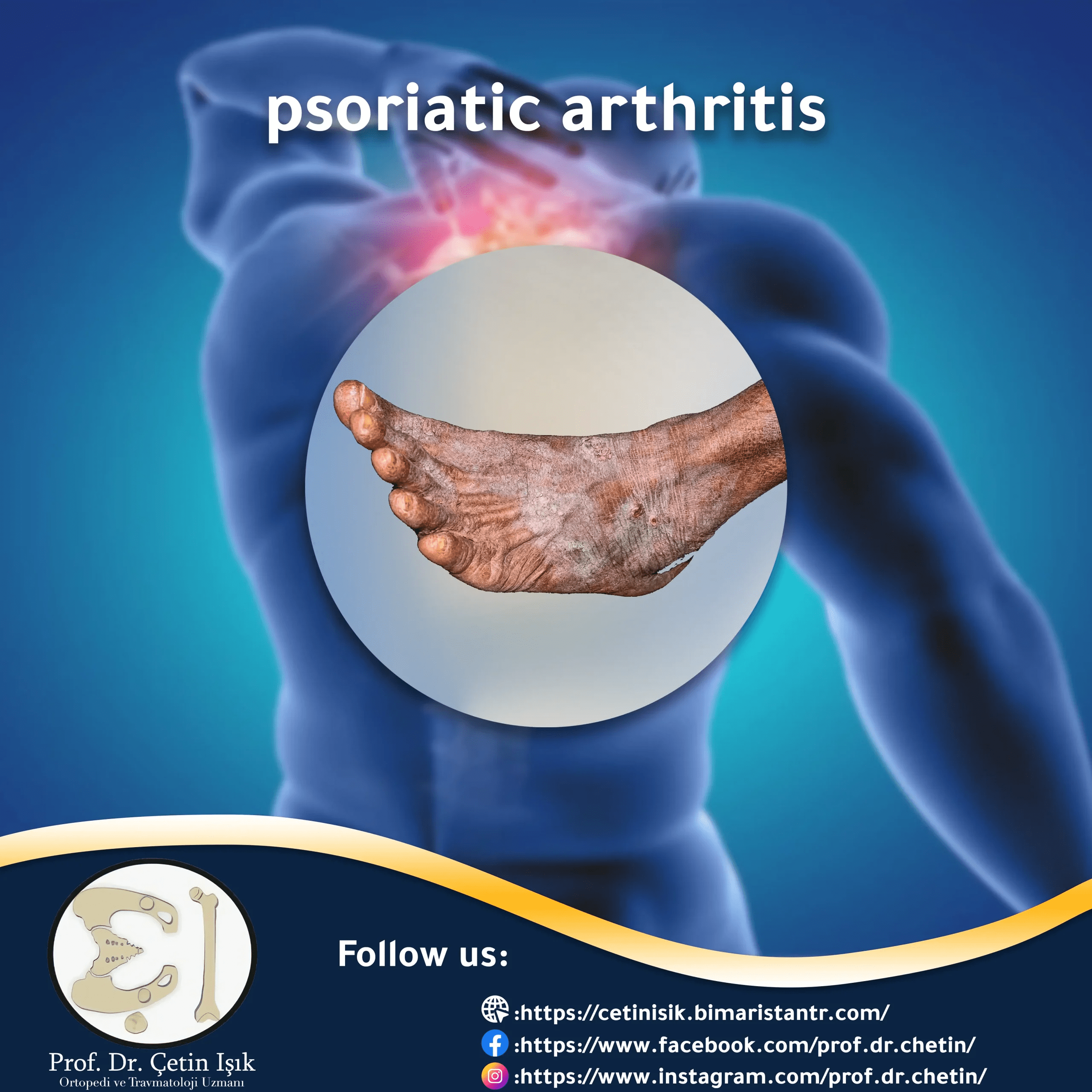 joint psoriasis; All information related to it Dr. What's wrong with you?