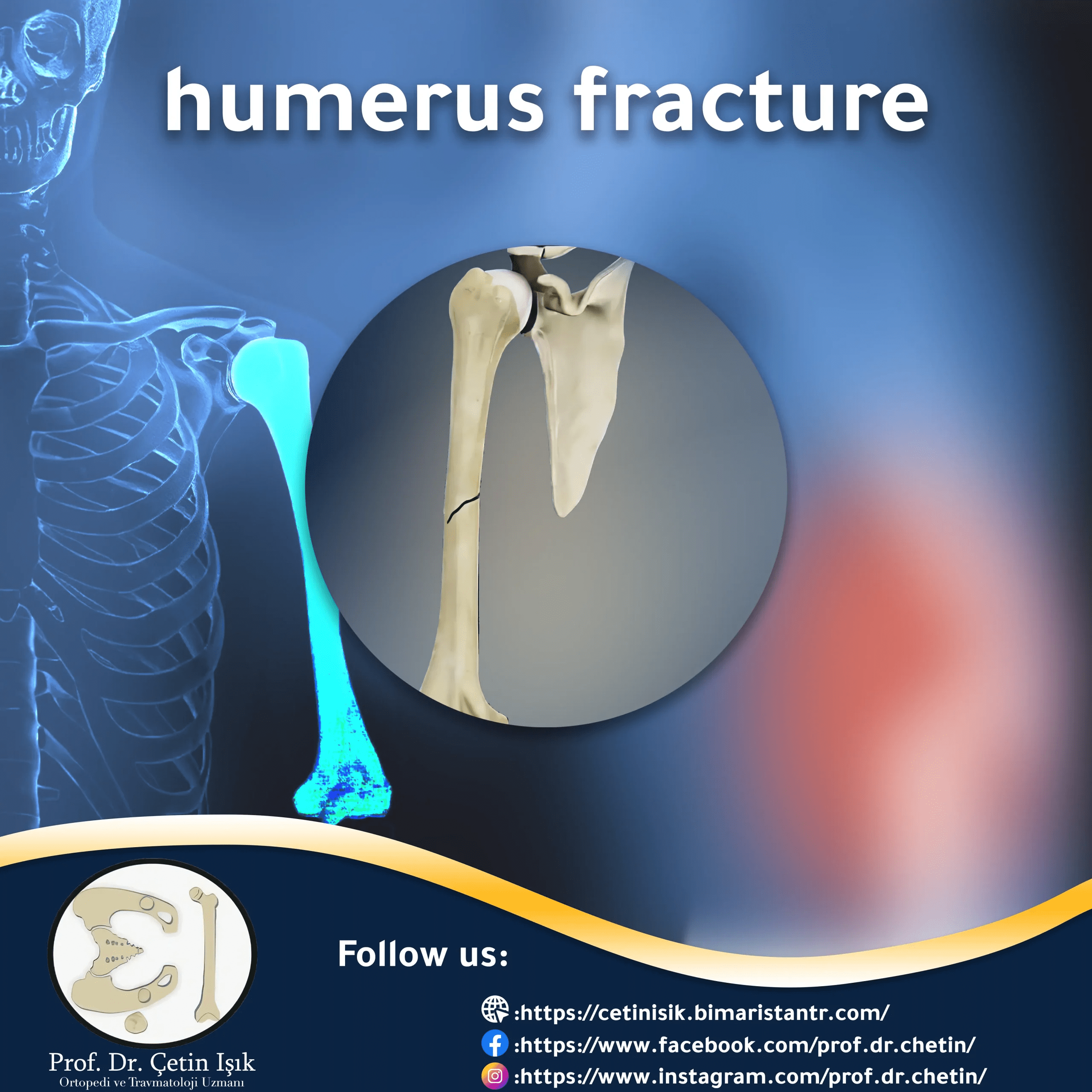 Humerus fracture; From diagnosis to treatment Dr. What's wrong with you?