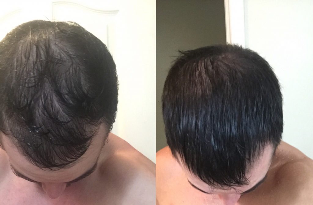 PRP Hair Loss Treatment Kelowna Naturopathic Doctor