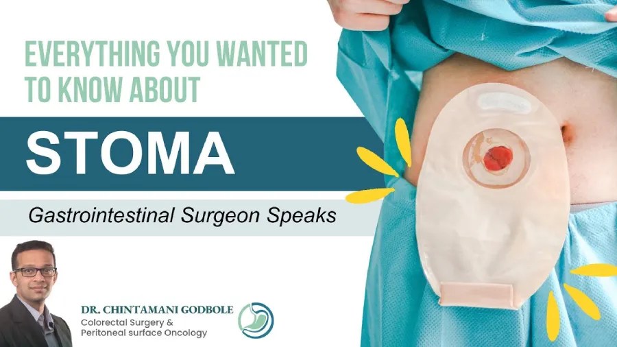 What is Stoma? How to Take Care of Stoma Bag Dr. Chintamani Godbole