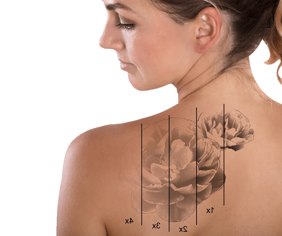 Tattoo Removal Dr. Chio Aesthetic & Laser Centre