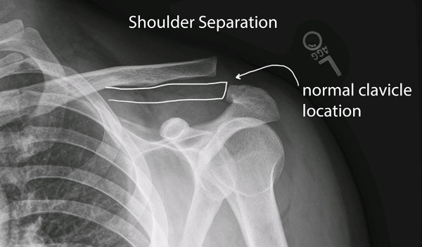 Shoulder Separations Dr. Michael Codsi Patient Education Michael