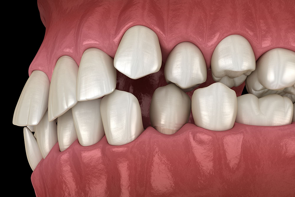 Problems That Can Arise From a Misaligned Bite Dabney Orthodontics