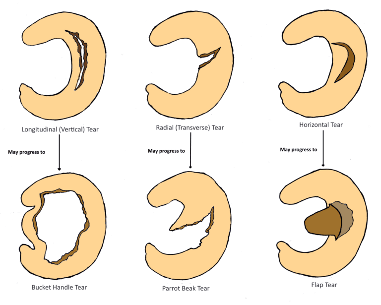 Meniscus Injury Dr. Dan Cohen Orthopedic Surgeon