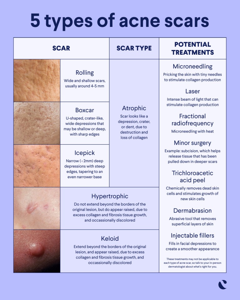 Acne Scar Treatment Guide to Achieving Your Smoother Skin - Physician