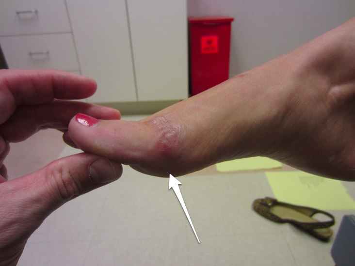 Turf toe Mechanism of injury and treatment options Dr Geier