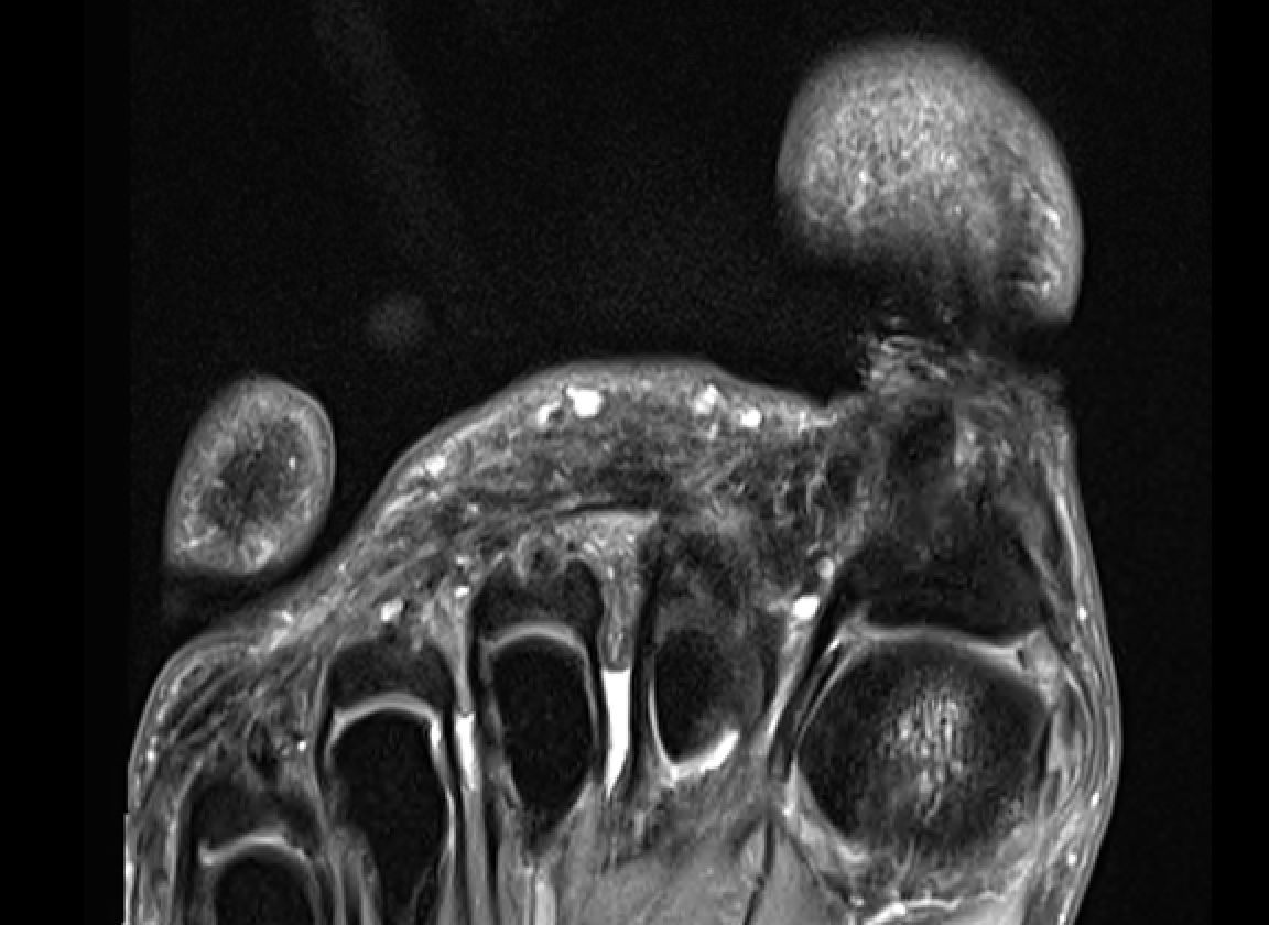 Morton's Neuroma David Shepherd