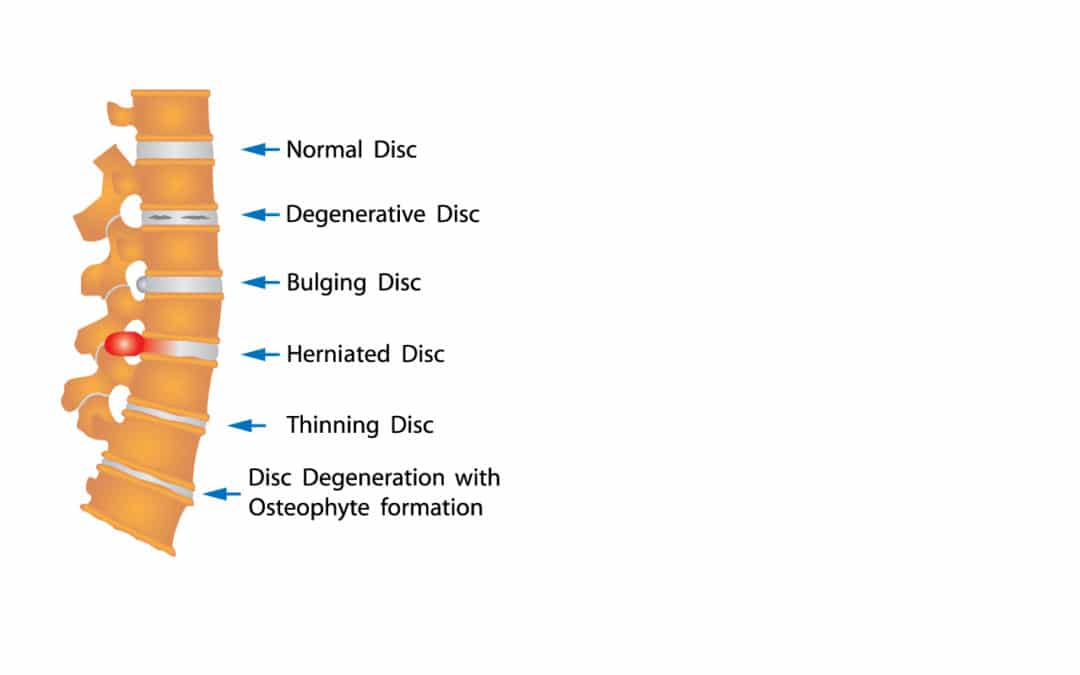 How Does Traction Help Back Pain? Dr. David Warwick
