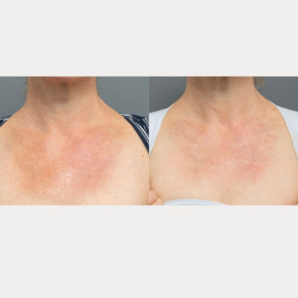 Neck And Chest Rejuvenation Gallery Dr Davin Lim