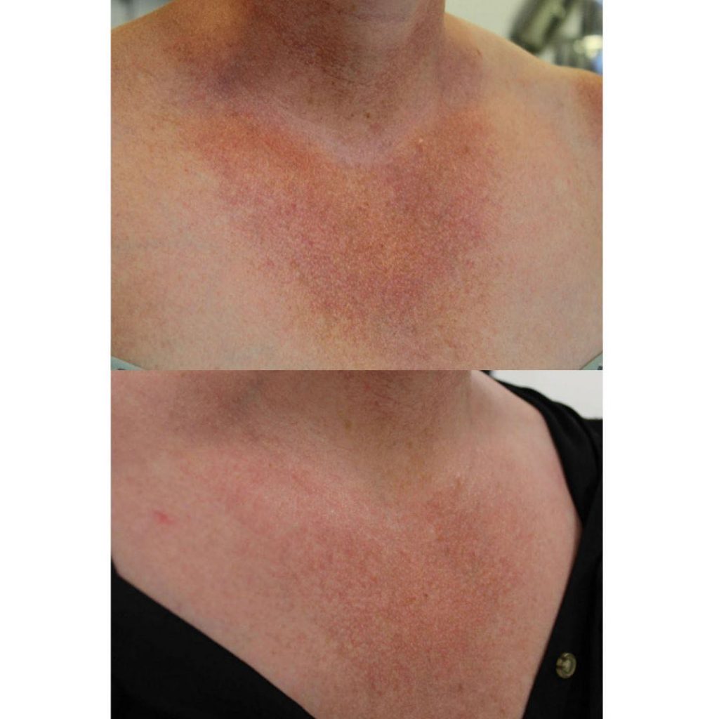 Neck And Chest Rejuvenation Gallery Dr Davin Lim