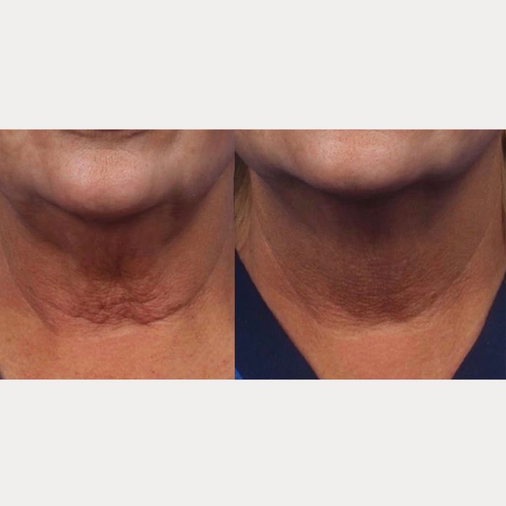 Neck And Chest Rejuvenation Gallery Dr Davin Lim