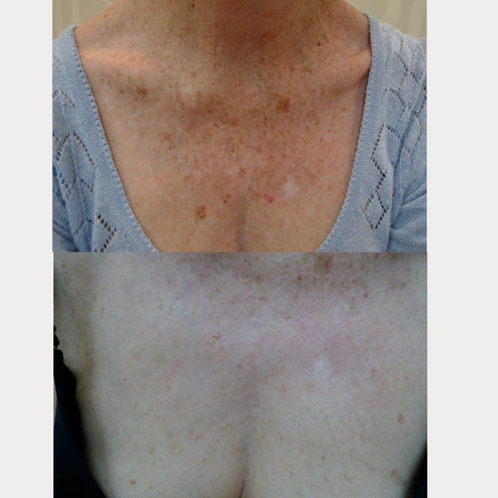 Neck And Chest Rejuvenation Gallery Dr Davin Lim