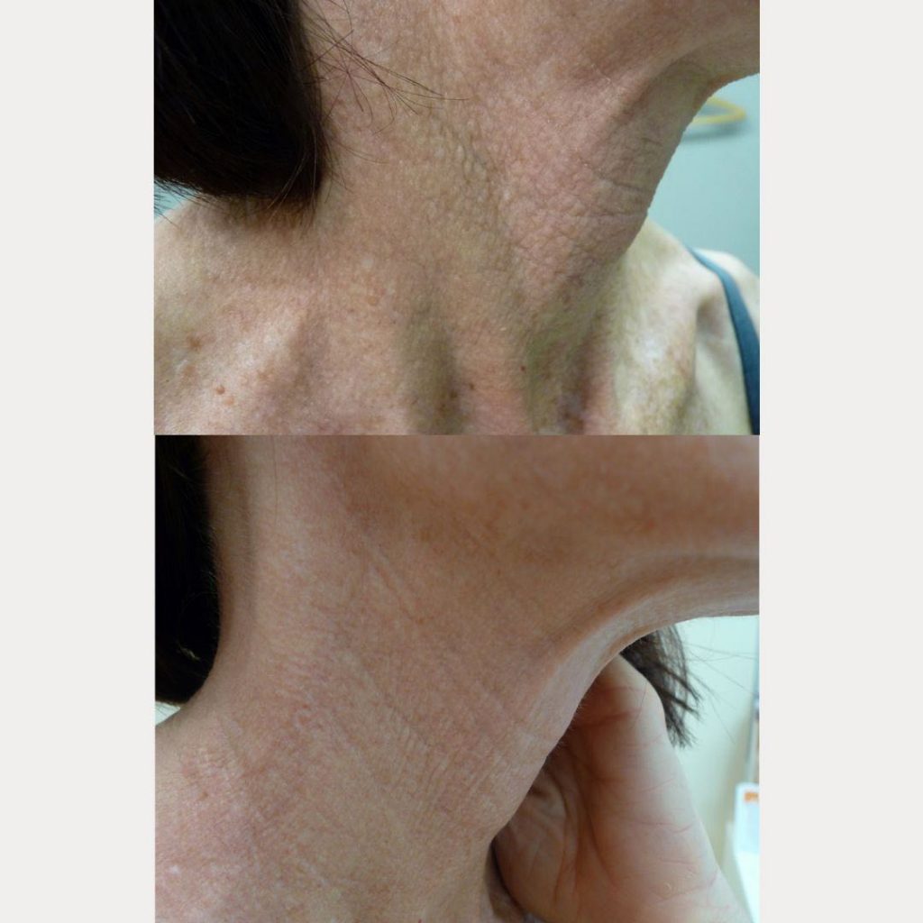 Neck And Chest Rejuvenation Gallery Dr Davin Lim