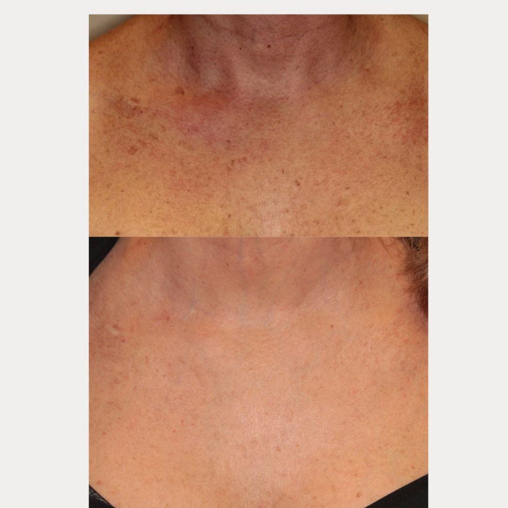 Neck And Chest Rejuvenation Gallery Dr Davin Lim