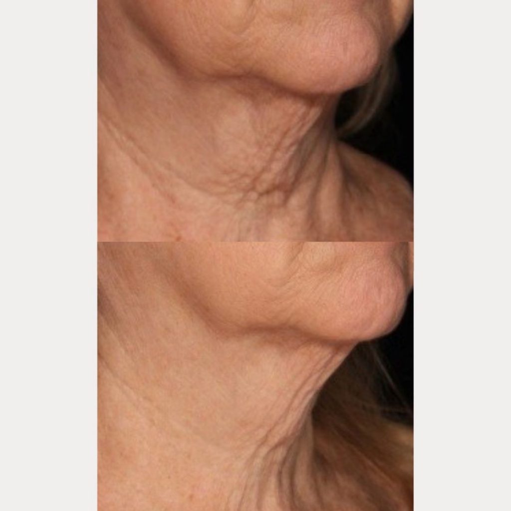 Neck And Chest Rejuvenation Gallery Dr Davin Lim