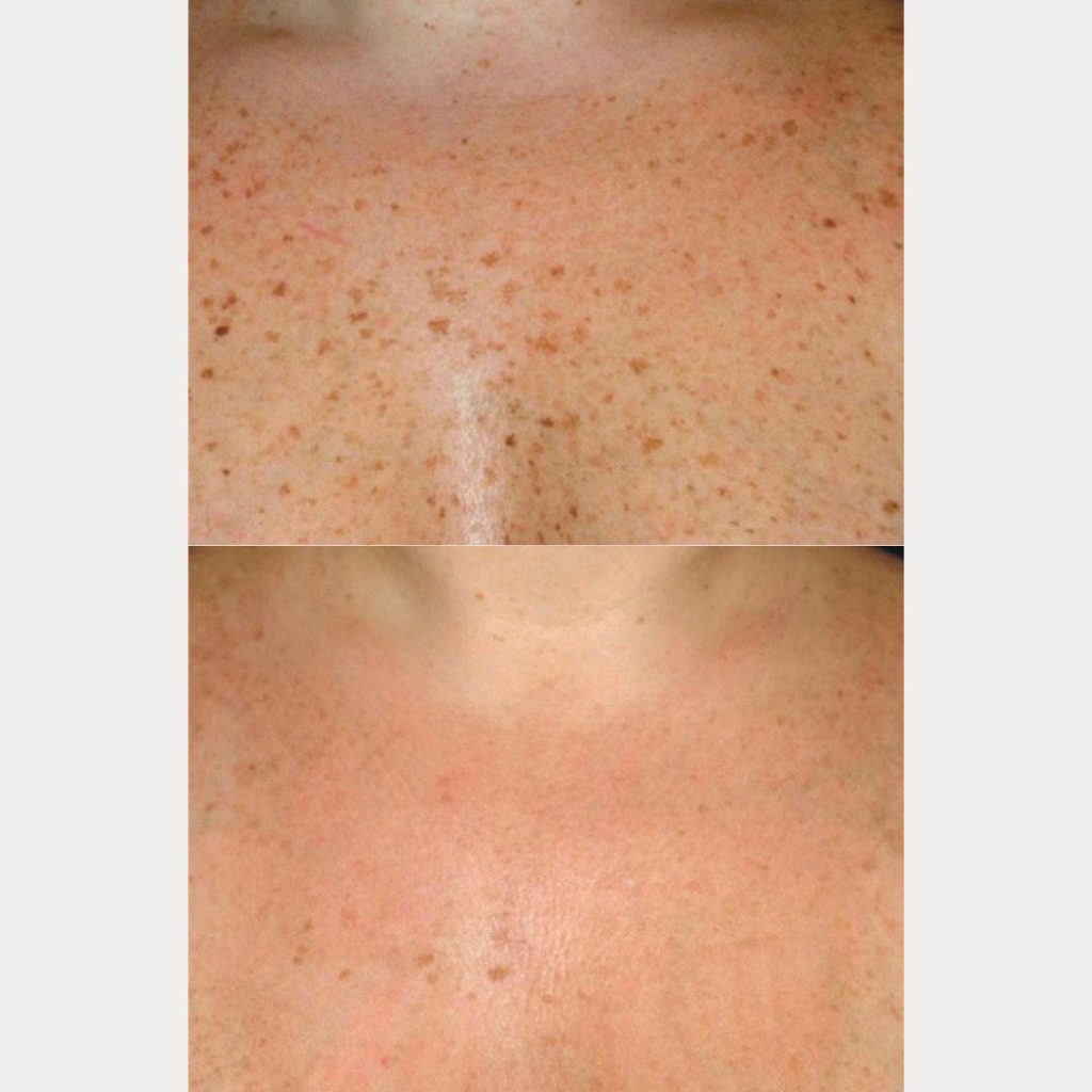 Neck And Chest Rejuvenation Gallery Dr Davin Lim