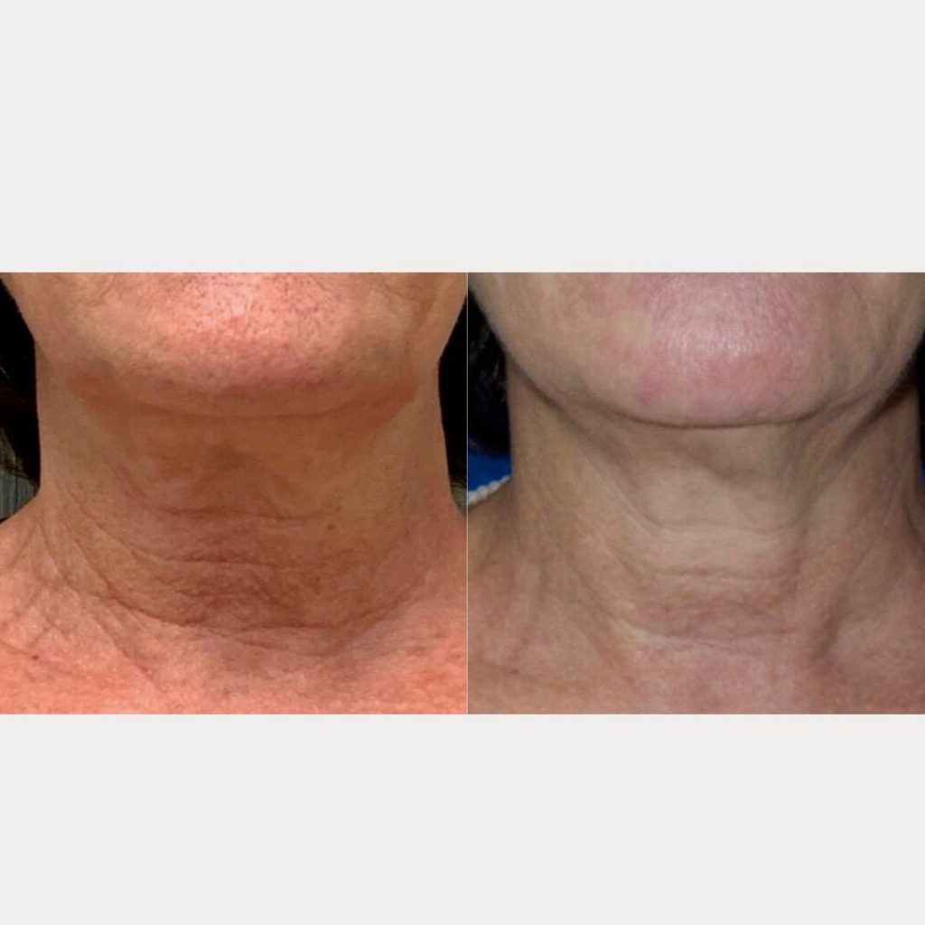 Neck And Chest Rejuvenation Gallery Dr Davin Lim