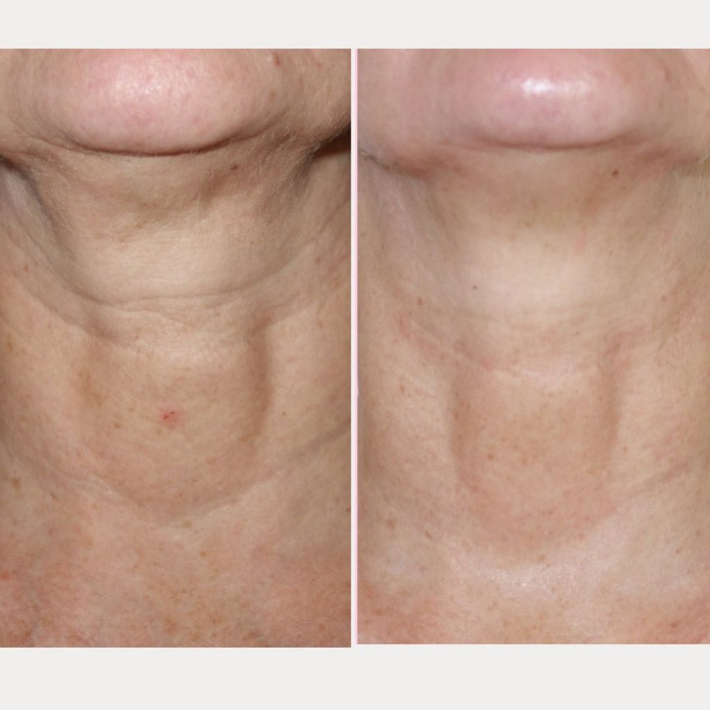 Neck And Chest Rejuvenation Gallery Dr Davin Lim