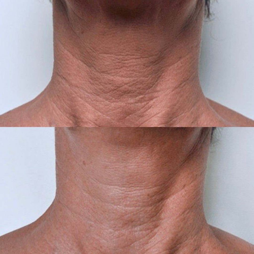 Neck And Chest Rejuvenation Gallery Dr Davin Lim