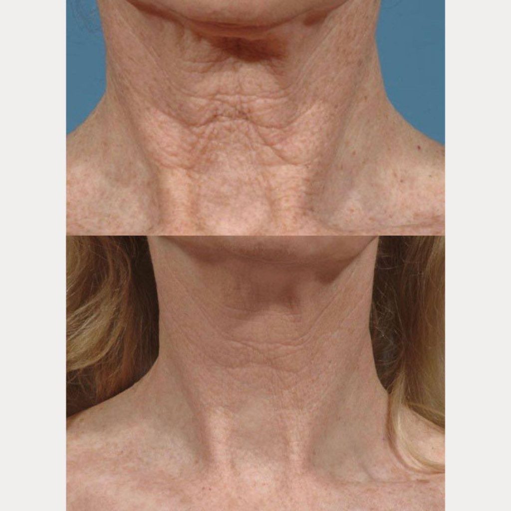 Neck And Chest Rejuvenation Gallery Dr Davin Lim