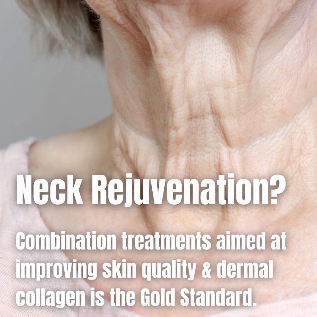 Neck And Chest Rejuvenation Gallery Dr Davin Lim