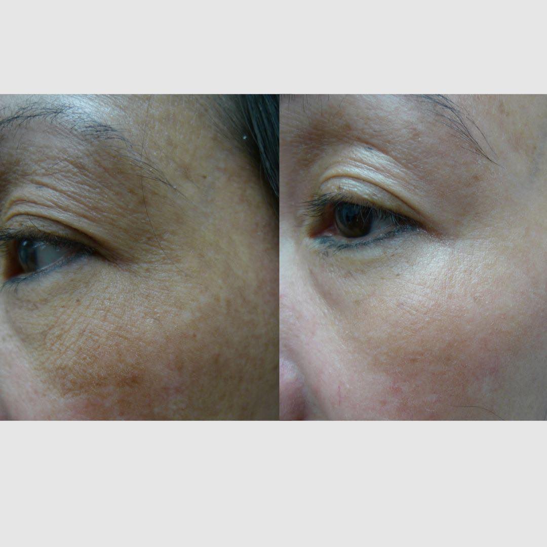 Best Dark Circles Treatments In Australia Dr Davin Lim