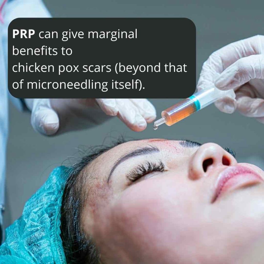 Chicken Pox Scars Dr Davin Lim Dermatologist