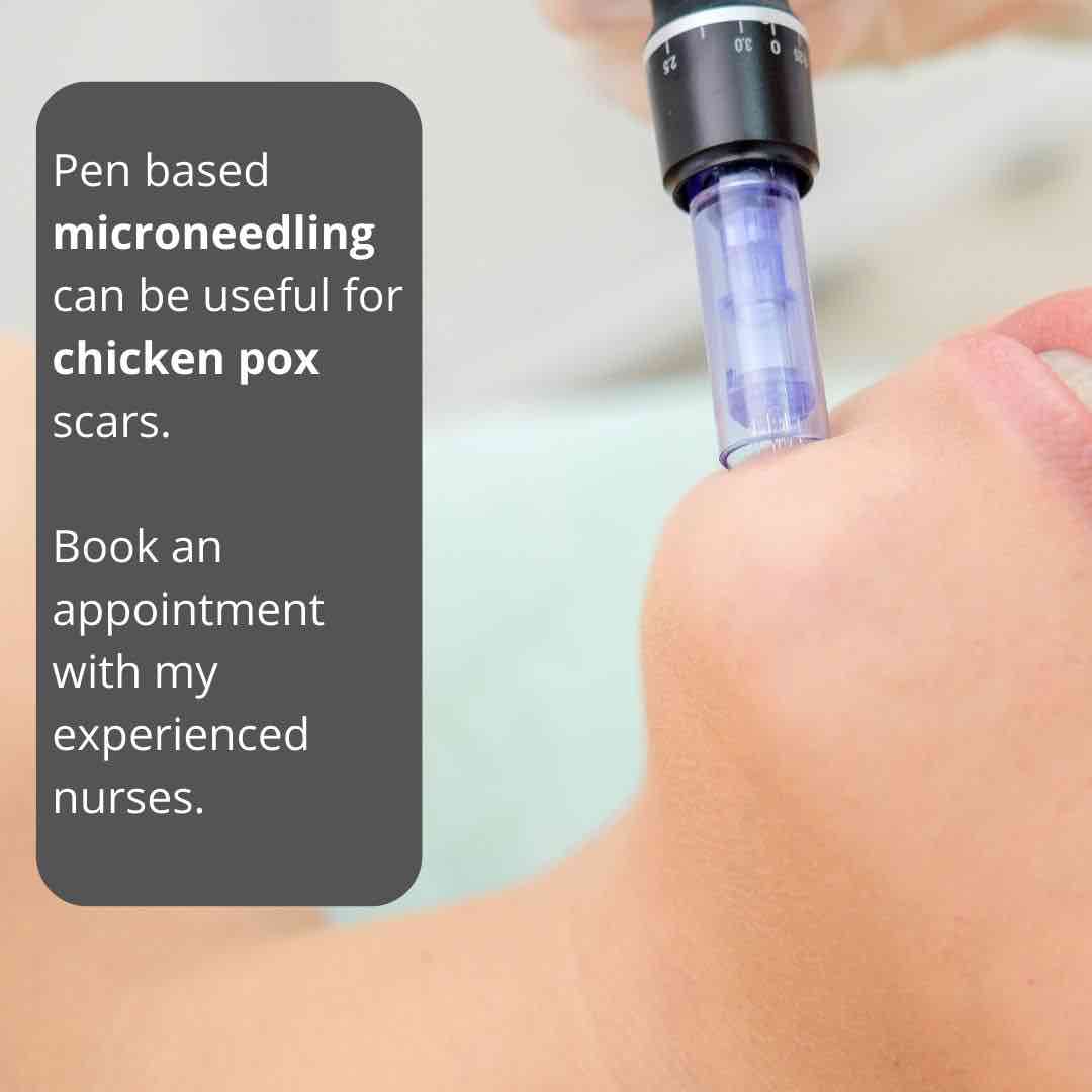 Chicken Pox Scars Dr Davin Lim Dermatologist
