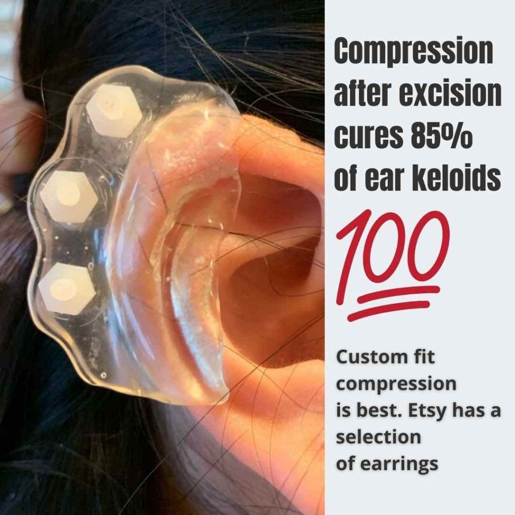 Best Ear Keloids Scars Treatment In Brisbane Dr Davin Lim