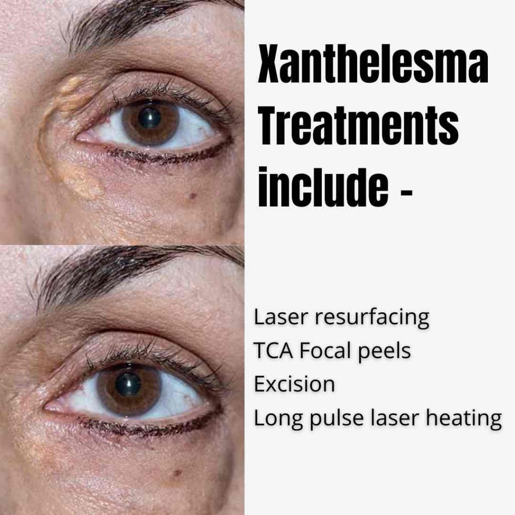 Best Xanthelasma Treatment In Australia 2024 Dr Davin Lim