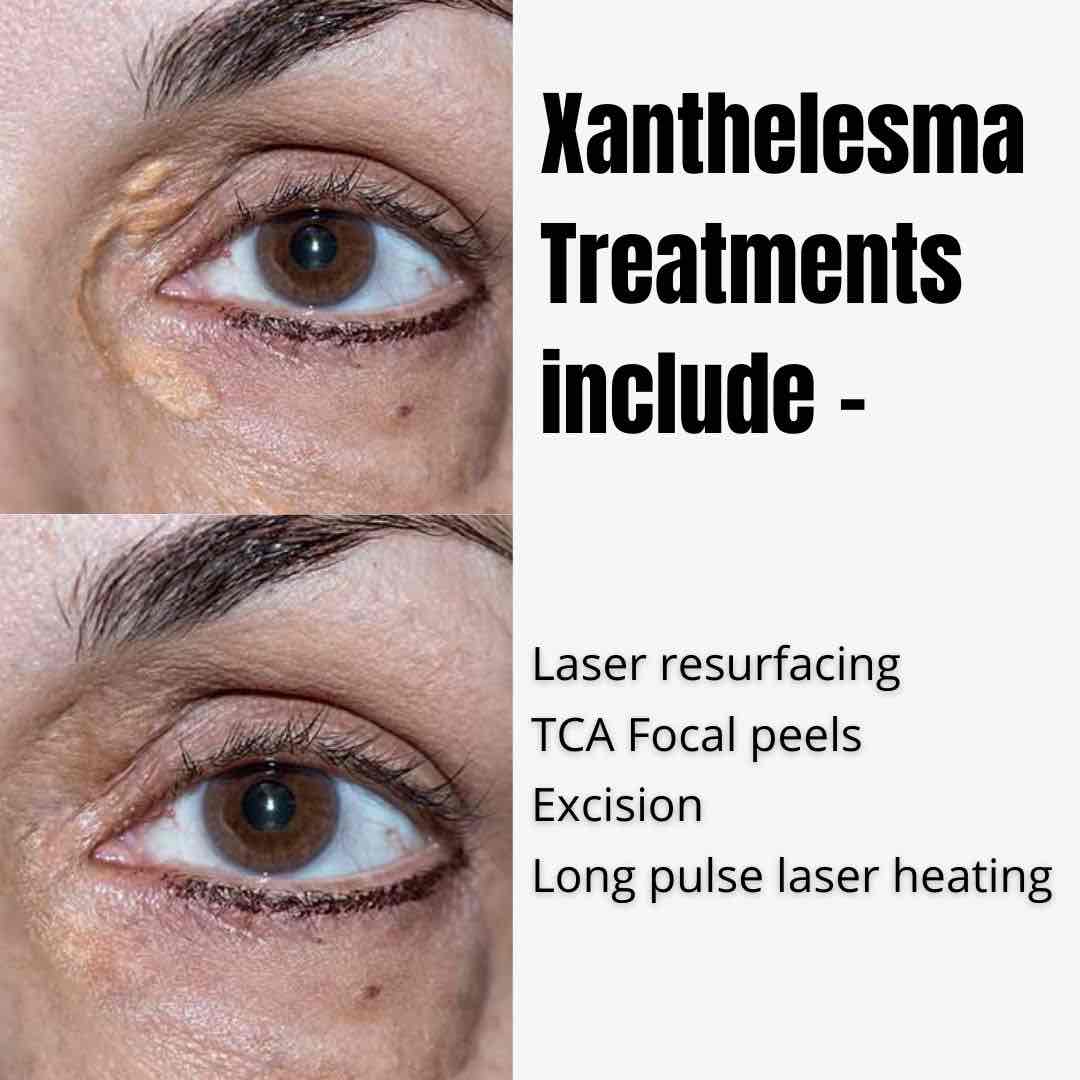 Best Xanthelasma Treatment In Australia 2024 Dr Davin Lim