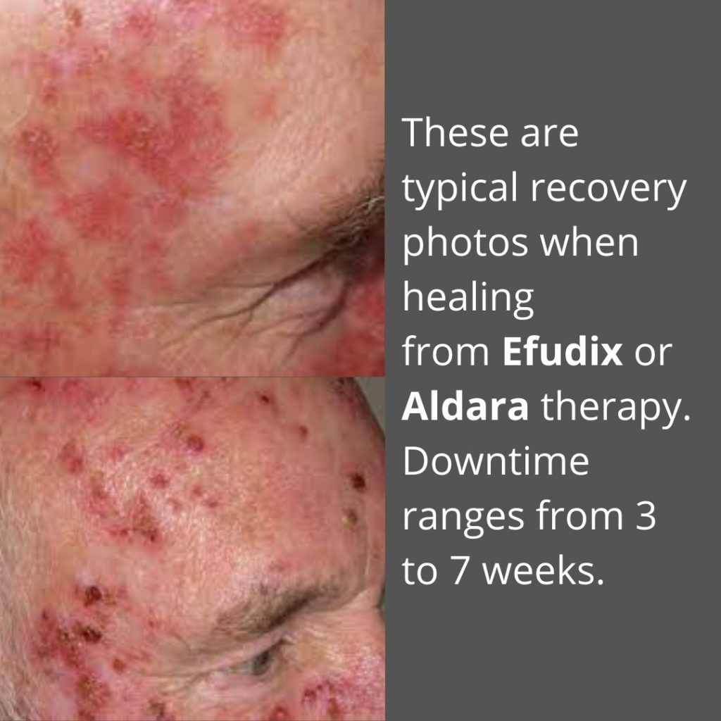 Best Efudix For Sun Spots Treatment In Brisbane Dr Davin Lim