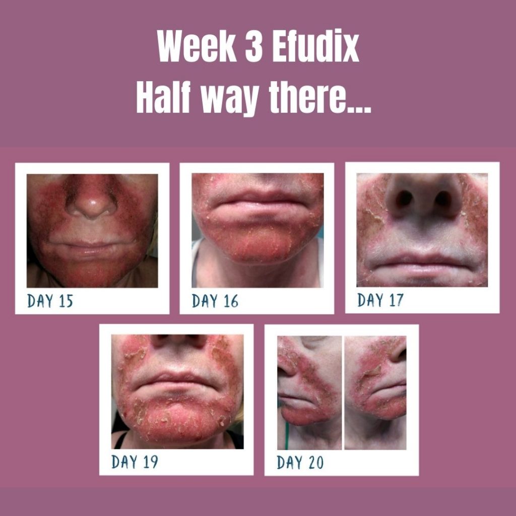 Best Efudix For Sun Spots Treatment In Brisbane Dr Davin Lim