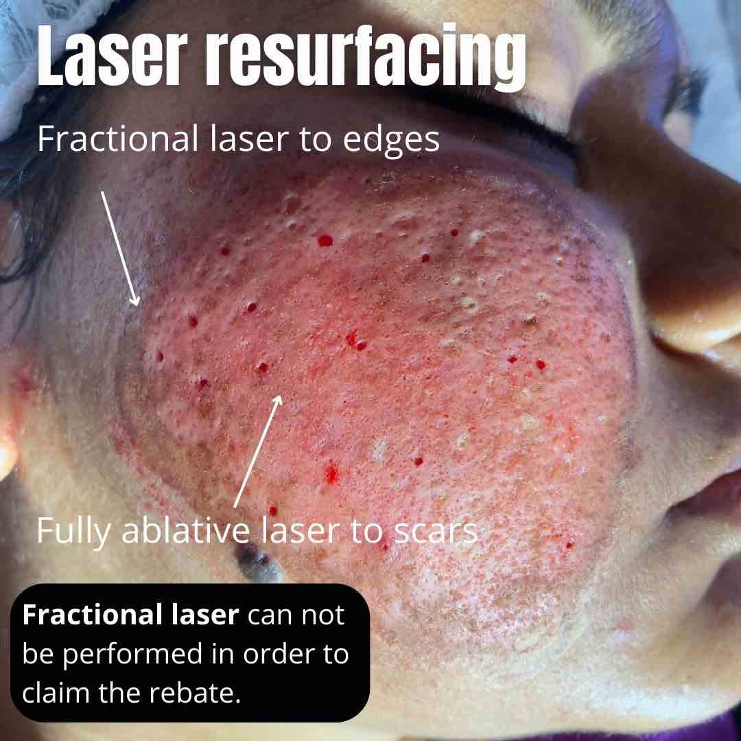 Laser Resurfacing Acne Scars Treatment In Australia 2024