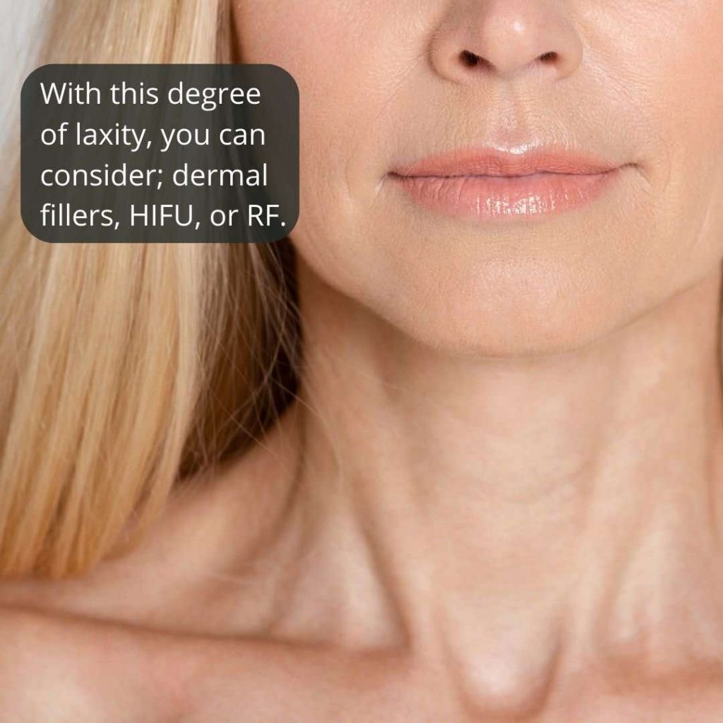 Neck And Chest Rejuvenation Gallery Dr Davin Lim