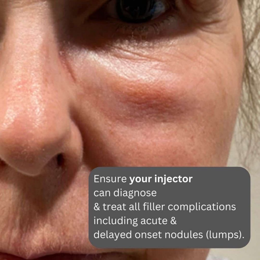 Dermal Fillers, Side Effects Dr Davin Lim