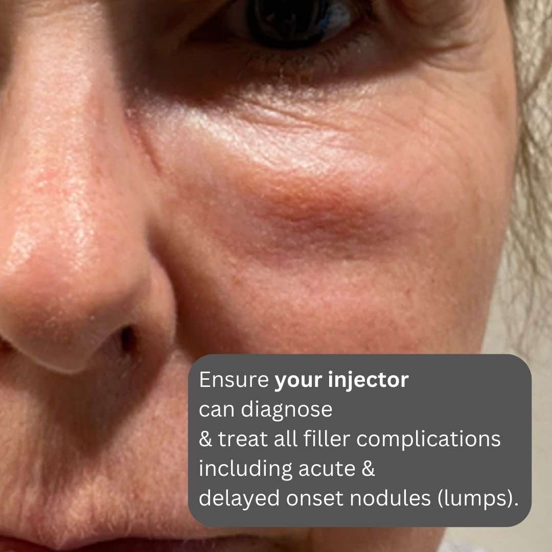 Dermal Fillers, Side Effects Dr Davin Lim