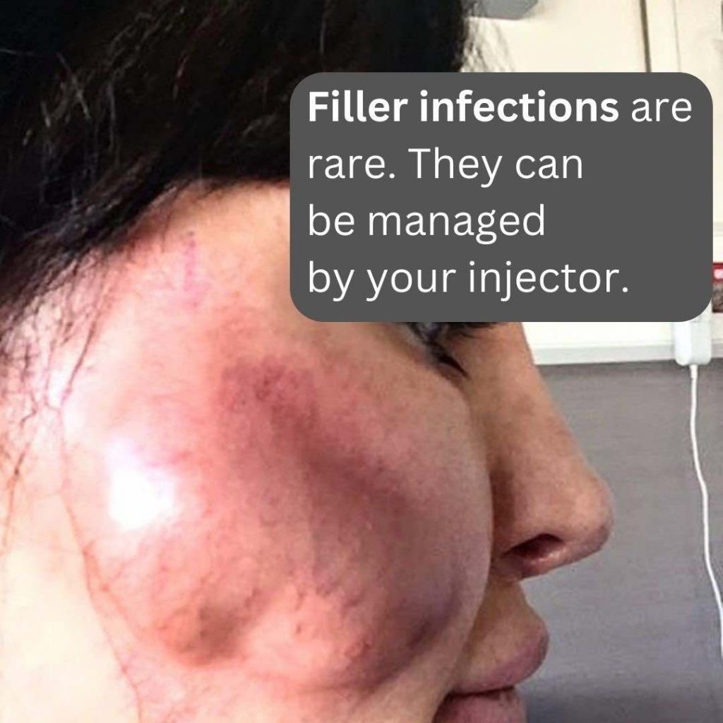 Dermal Fillers, Side Effects Dr Davin Lim