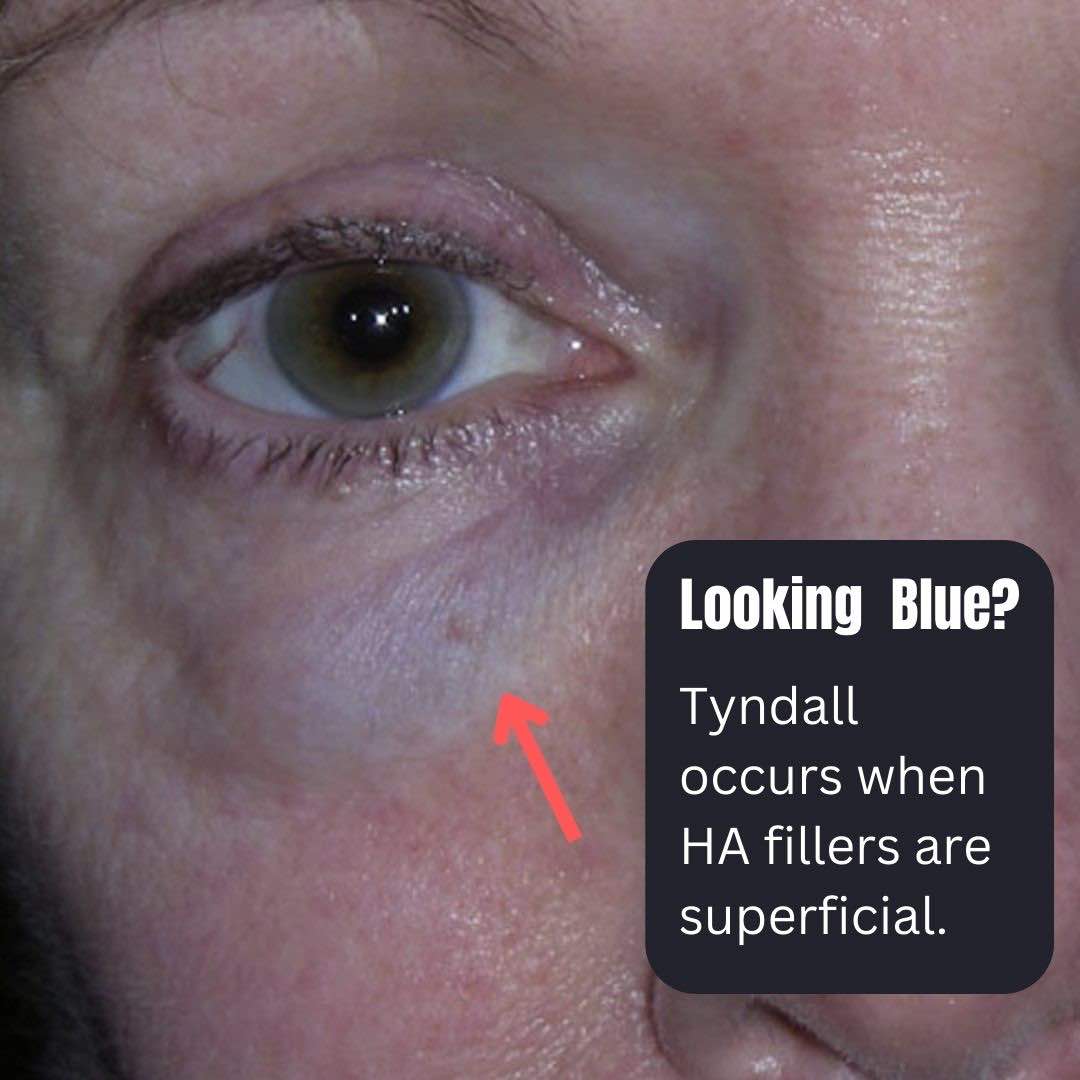 Dermal Fillers, Side Effects Dr Davin Lim