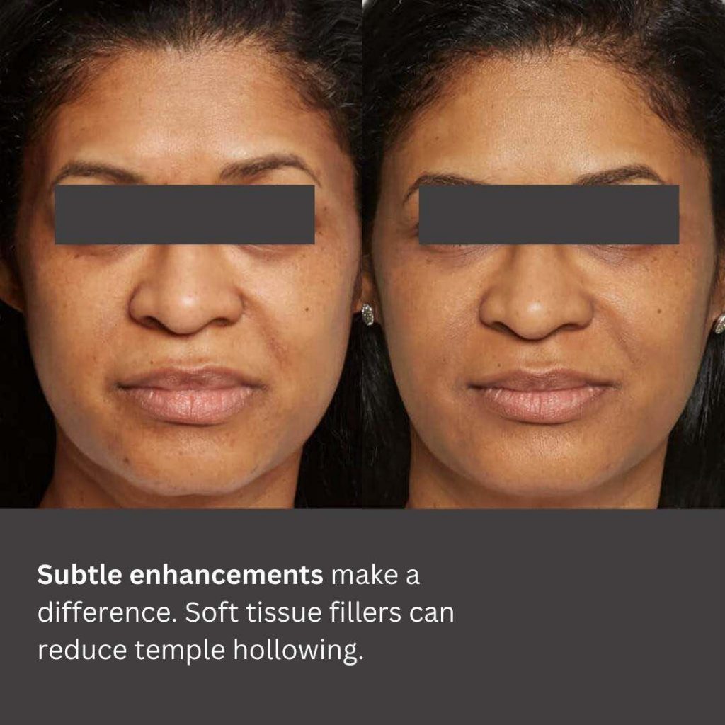 Temple Fillers Dr Davin Lim