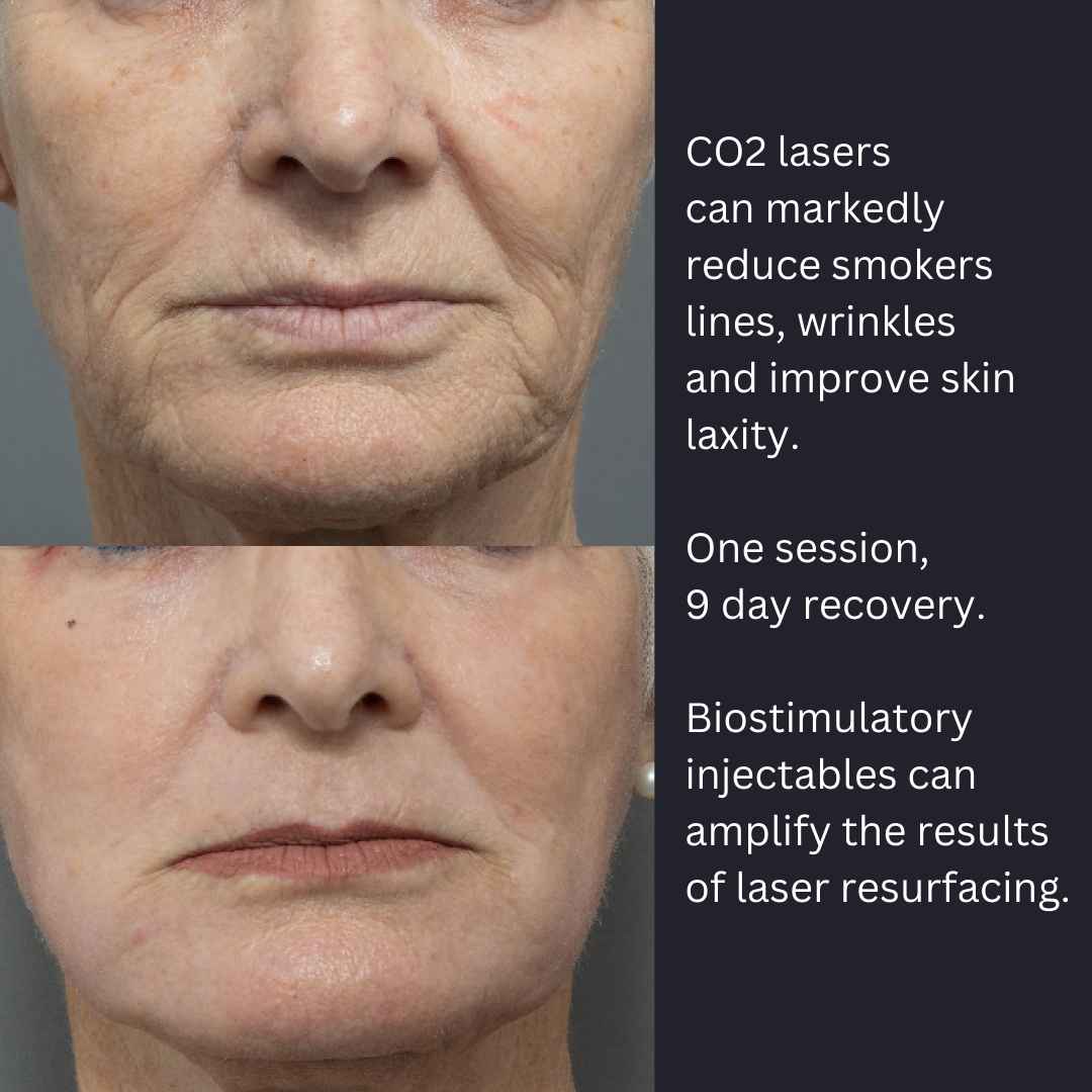Best CO2 Laser Resurfacing Near Me Dr Davin Lim