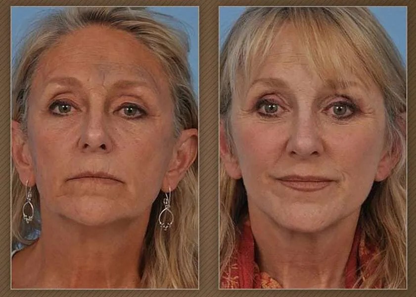 Neck Lift Chicago Chicago Plastic Surgeon Dr. Steven Dayan