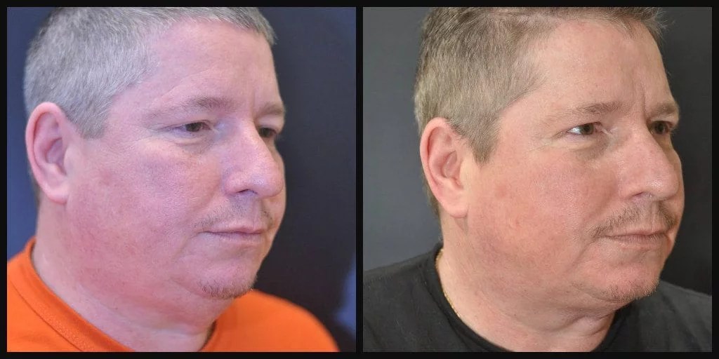 CoolSculpting Before and After Photo Gallery Dr. Kane