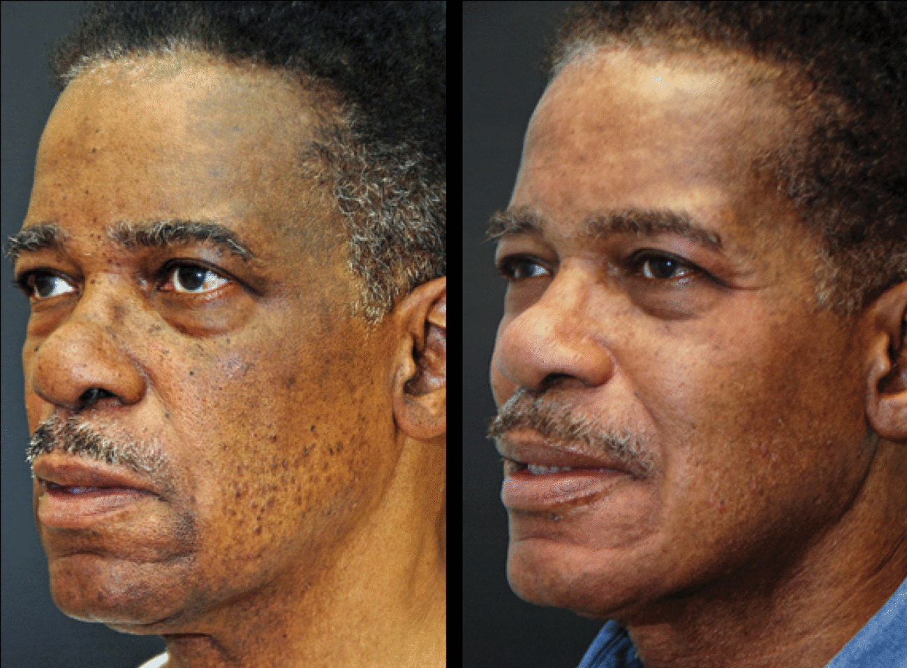 TCA or Dr. Obagi ZO 3Step Peel® for Men Dr. Dean Kane