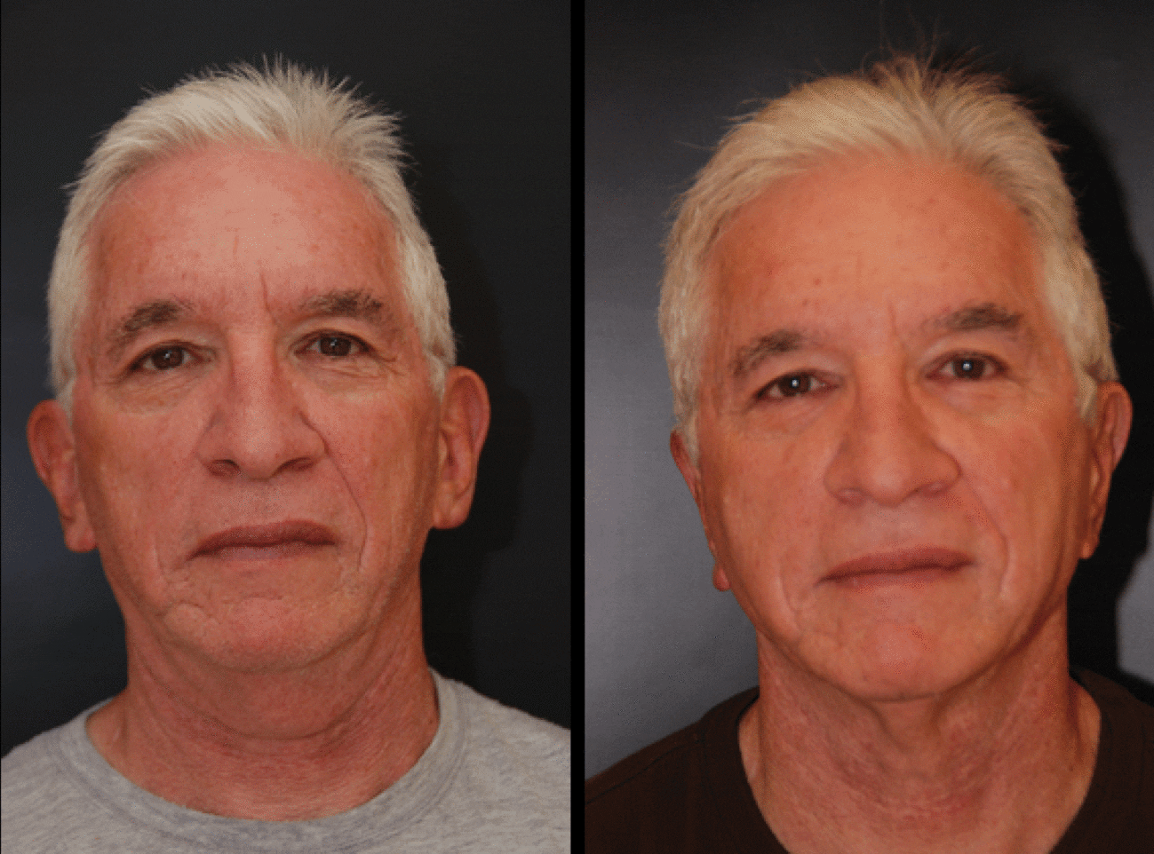 Male Otoplasty Ear Pinning the Center for Cosmetic Surgery