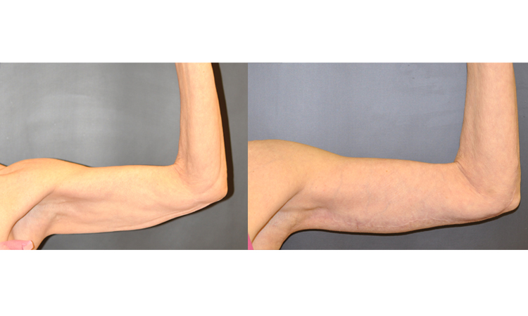 Arm Liposuction, Tucks, and Brachioplasty Dr. Dean Kane