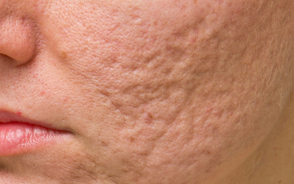 10 Acne Scar Treatments By The Dermatologist