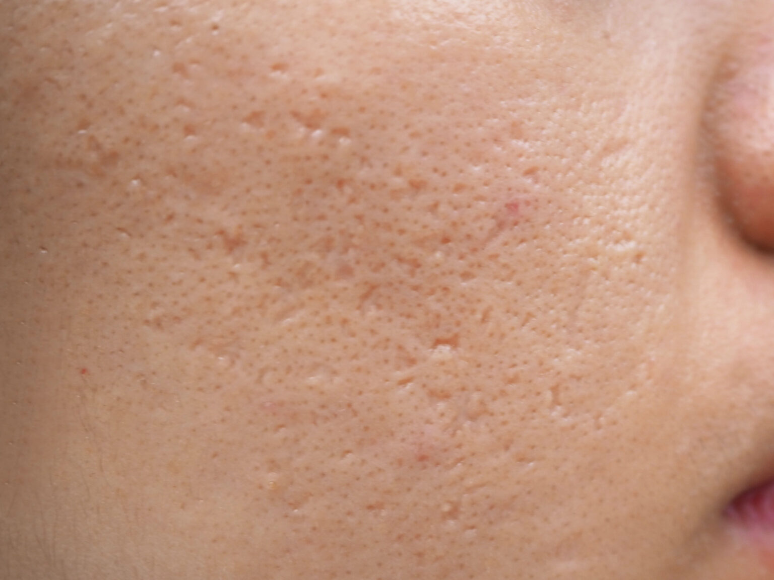 10 Acne Scar Treatments By The Dermatologist